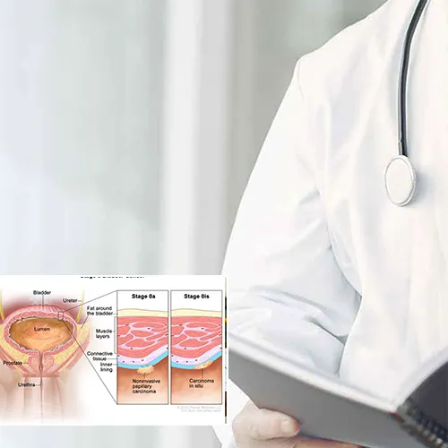 Understanding the Process of Penile Implants with   Advanced Urology Surgery Center 
 


